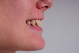 Implantation anormale de certaines dents (malocclusion)