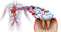Inflammation de la paroi interne du cœur (endocardite)