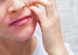 Inflammation autour de la bouche (dermatite périorale)