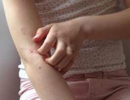 Eczéma atopique (dermatite atopique) chez l’enfant