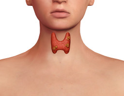 Thyroïde : nodules et goitre