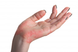 Dermatite de contact irritante