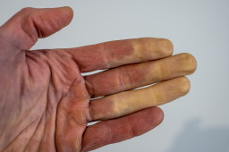 Doigts et orteils blancs et froids (syndrome de Raynaud) ou bleu-rouge (acrocyanose)