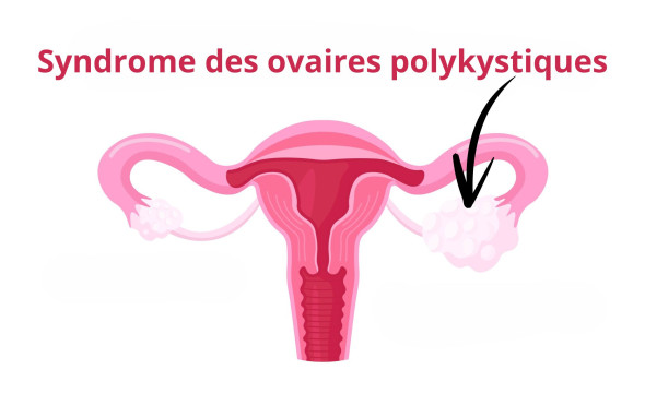 Syndrome des ovaires polykystiques