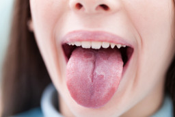 Inflammation de la langue (glossite)